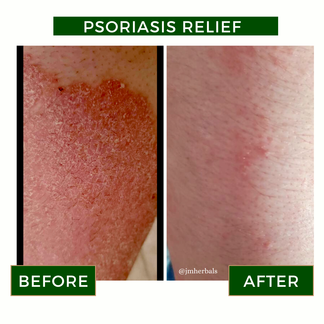 Organic Calendula Healing Salve for Diaper Rash, Eczema, Stretch Marks, & Nipple Care – All-Natural Remedy for Sensitive Skin